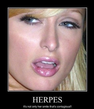Herpes.jpg