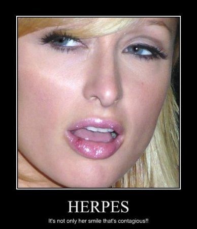 Herpes.jpg